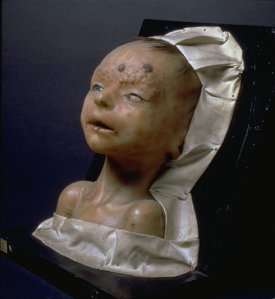 Moulage d'un bébé hérédo-syphilitique